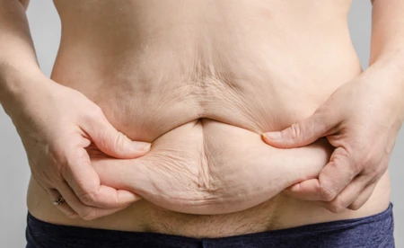 Jak poradzić sobie z luźną skórą po schudnięciu? - FILM