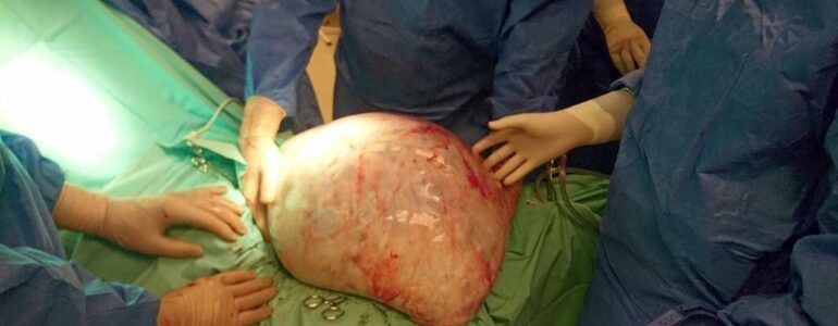 Lekarze wycięli młodej pacjentce około 30-kilogramowego guza – FILM, FOTO